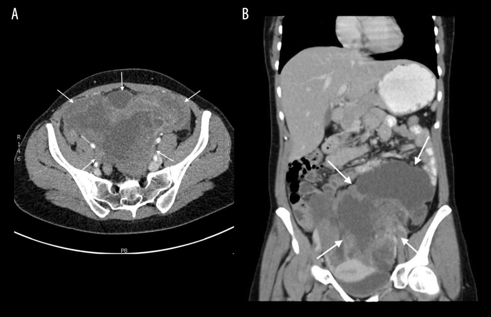 Computed tomography scan showing a left ovarian tumor (white arrows) with the size of 20×20×19 cm: (A) axial view and (B) coronal view.