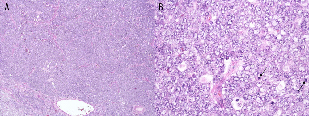 Ovarian parenchyma with cells that have monomorphic round nuclei with vesicular chromatin and small nucleoli (hematoxylin and eosin stain). (A) Follicle-like spaces (white arrows) and (B) numerous mitotic figures (black arrows) are present.