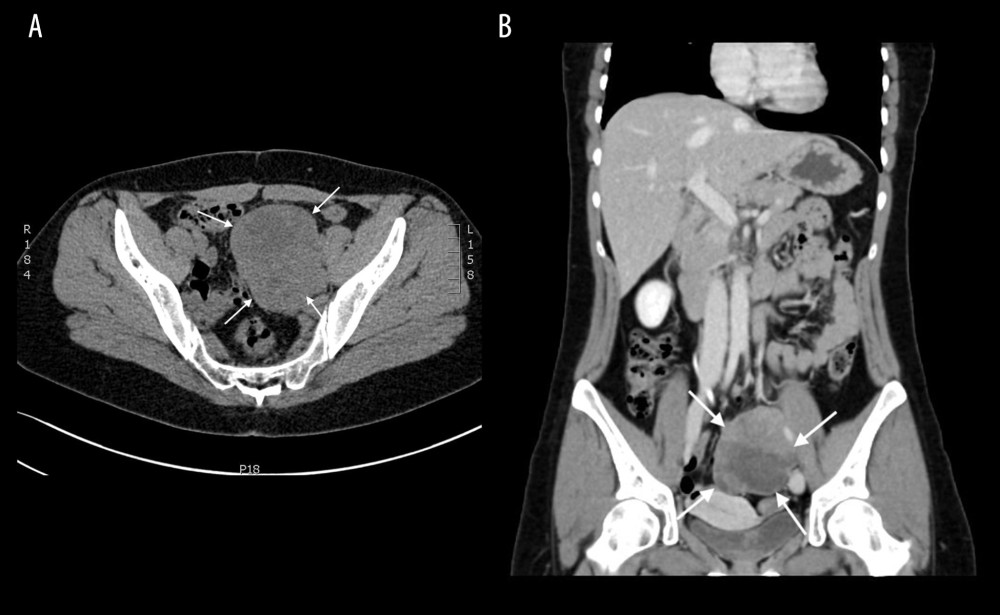 Computed tomography scan showing recurrent tumor (white arrows) on the left side of the pelvis near the iliac vein with cystic and solid components: (A) axial view and (B) coronal view.
