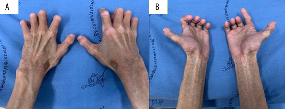 His hands demonstrated aged-looking skin, joint stiffness with decreased joint mobility, and a loss of subcutaneous fat (A: prone position) (B: supine position).
