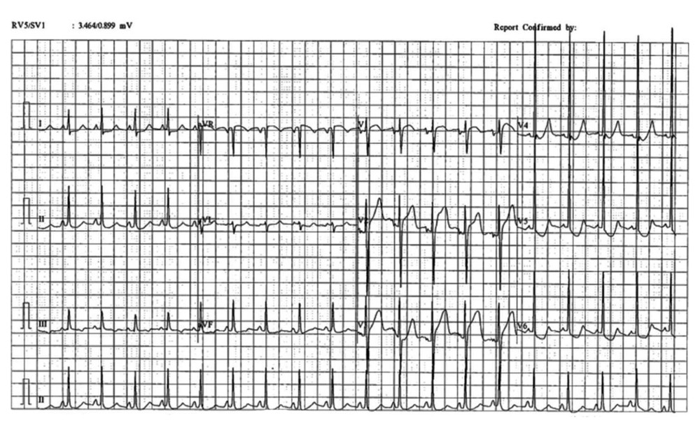 The 12-lead ECG showed sinus tachycardia, normal axis, left ventricular hypertrophy, and widespread horizontal ST-segment depression in I, aVL, II, III, aVF, and V4–V6, and ST elevation in aVR and V1. In the setting of acute coronary syndrome, this ECG usually indicates left main heart disease or a significant proximal LAD occlusion.