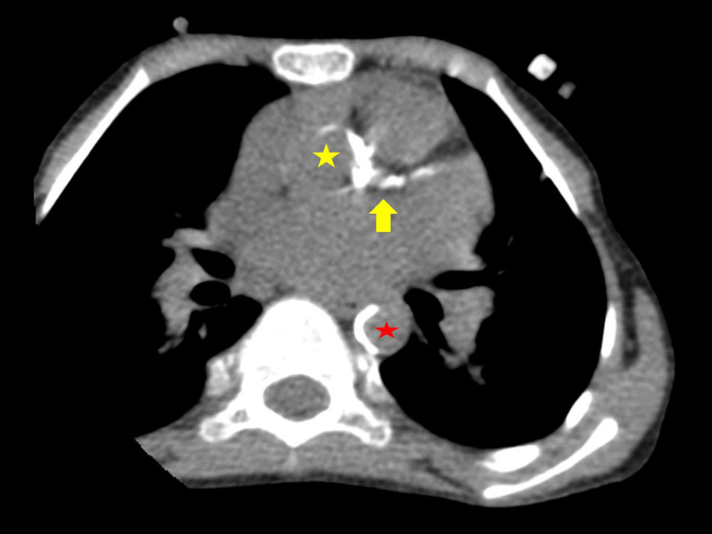 Cardiac computed tomography for coronary calcium score showing calcification of the aortic valve (yellow asterisk), coronary artery (arrow) including left main and proximal left anterior descending artery (LAD), and along the descending thoracic aortic wall (red asterisk). The calcium score was 126 Agatston units (AU). This appearance indicates the presence of progressive arteriosclerosis and associated cardiovascular abnormalities.