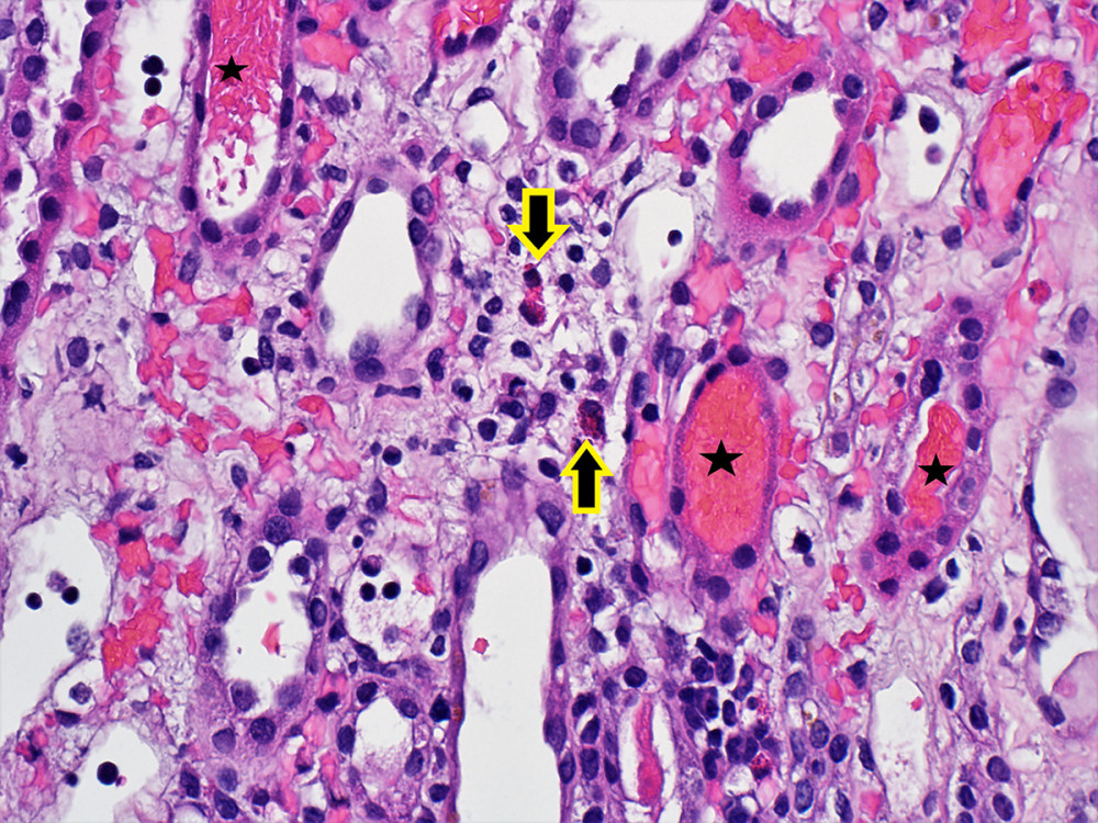 Photomicrograph depicting renal biopsy with marked interstitial edema and renal tubules full of red blood cells (stars). Inflammatory cells including lymphocytes and eosinophils (arrows) are seen within the interstitium. Hematoxylin and Eosin stain; original magnification ×400.