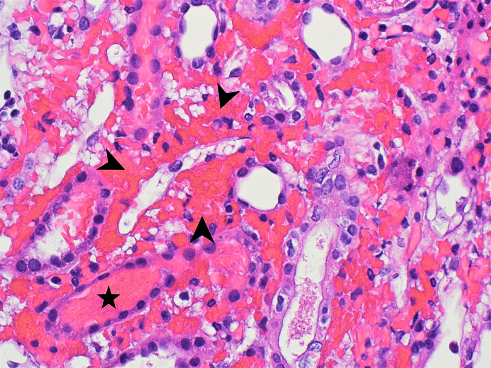 Renal tissue with marked interstitial (arrowheads) and intratubular hemorrhages (star). Hematoxylin and Eosin stain; original magnification ×400.