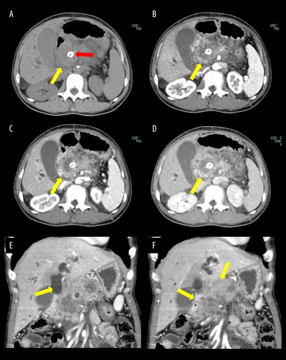Findings of the contrast computed tomography (CT) scan of the abdomen. (A) Un-enhanced, (B) arterial, (C) portal, and (D) delayed CT scans. Gradual contrast effect was observed in areas surrounding the tumor (yellow arrow) with calcification in the inner region (red arrow). (E) The intrapancreatic bile duct in the pancreas was displaced by the tumor with dilatation of the intrahepatic bile duct (yellow arrow). (F) The boundary between the stomach and duodenum was unclear, and tumor invasion was suspected (yellow arrow).