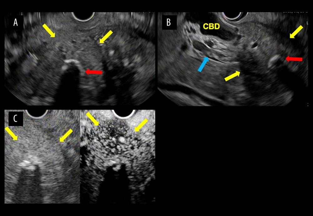 Endoscopic ultrasound images. (A) Tumor mass consisted of partial low-absorption regions considered to be the areas of tumor necrosis (yellow arrow) and high-absorption regions with an acoustic shadow considered to be the calcification of the nearby tumor (red arrow). (B) The common bile duct had expanded, and the tumor obstructed the portal vein (blue arrow). (C) Contrast-enhancement was achieved with perflubutane.