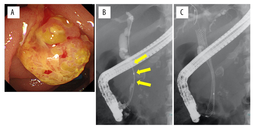 Endoscopic retrograde cholangiopancreatography images. (A) The tumor invaded the minor duodenal papilla. (B) Stenosis of the bile duct was visible by contrast-enhancement of the biliary tract (yellow arrow). (C) For the regions of stenosis, a covered self-expandable metallic stent was placed endoscopically.