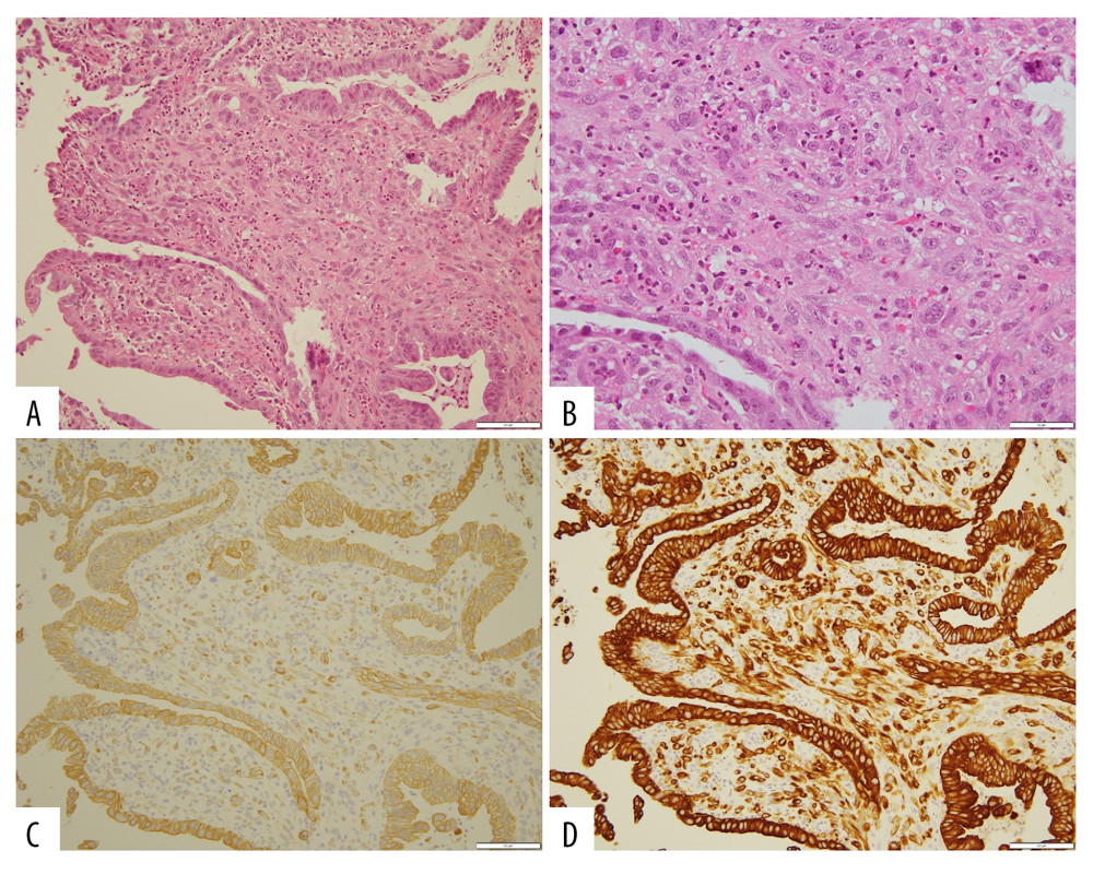 Tissue biopsy of the minor duodenal papilla. Hematoxylin and eosin staining of the tumor under (A) 20× and (B) 40× magnification. Immunohistochemistry images of (C) AE1/AE3 and (D) CAM5.2 under 20× magnification.