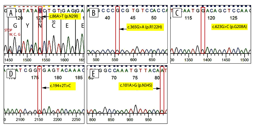 Gene analysis. (A–C) PRSS1 gene, (D, E) SPINK1 gene. The PRSS1 gene was negative for all p.N29I, p.R122H, and p.G208A mutations. The SPINK1 gene was negative for both c.194+2T>C and p.N34S mutations.