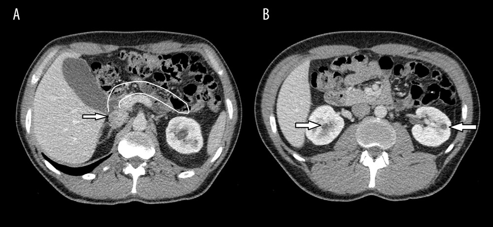 Axial contrast-enhanced computed tomography image showing the absence of the pancreatic body and tail. (A) The arrow shows the pancreatic head; (B) arrows identify the renal cysts.