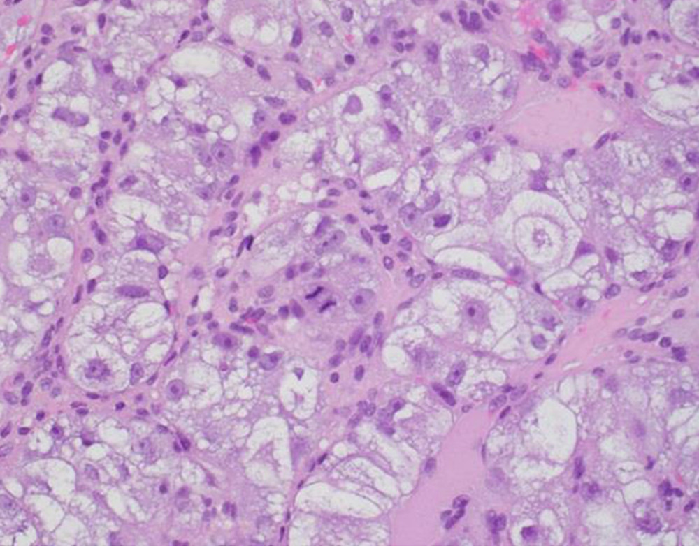Skin punch biopsies with large cells with prominent nucleoli, clear cytoplasm, and distinct, thin cell borders arranged in nests and tubules, consistent with clear-cell renal cell carcinoma, ×40 magnification. The primary tumor was found to have very irregular nuclei, with large and prominent nucleoli.