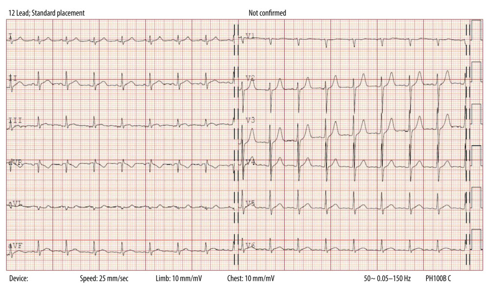 Electrocardiogram at admission, demonstrating an ascending ST-elevation in the precordial leads.