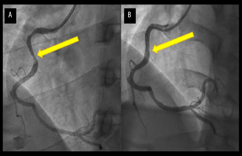 (A) Coronary angiography showing the proximal right coronary artery stenosis pre-percutaneous coronary intervention. (B) Coronary angiography of the right coronary artery post-percutaneous coronary intervention. The yellow arrows point to the stenotic lesions.