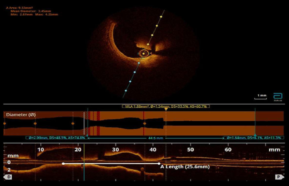 Optical coherence tomography of the proximal right coronary artery at the level of the stenosis. The upper part of the figure depicts a cross-section of the vessel and the presence of the (red) thrombus. The lower part of the figure shows a longitudinal section of the lesion and its length (25.6 mm).