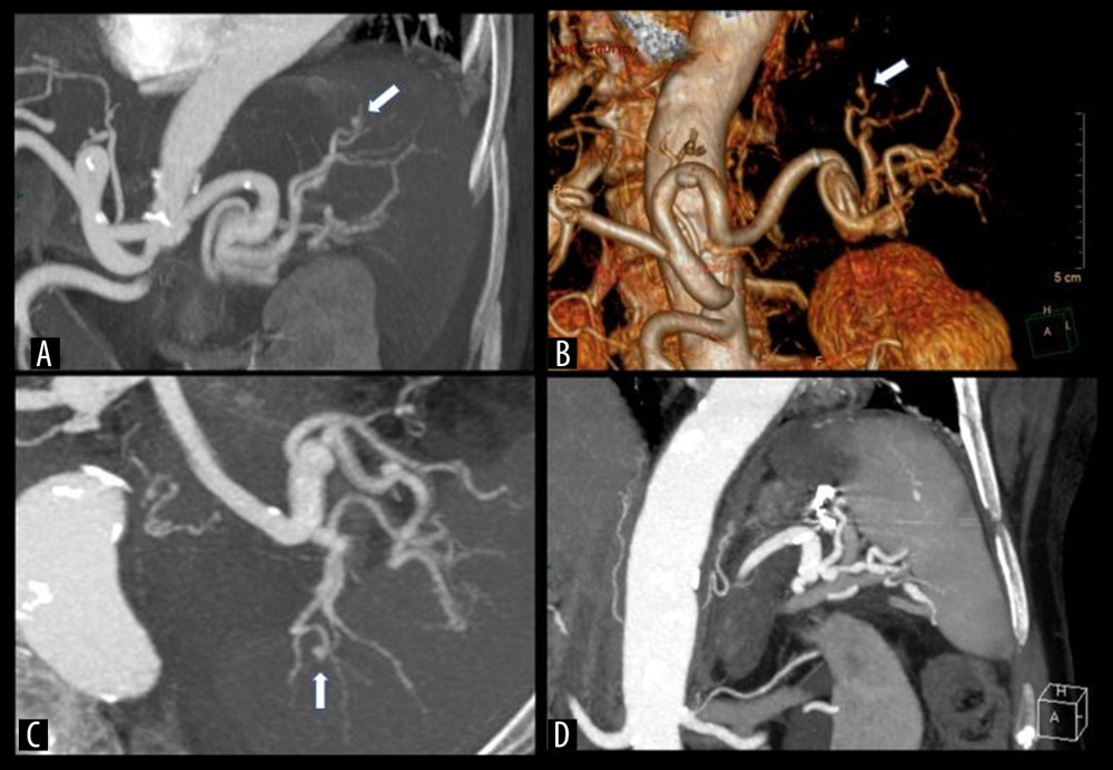 Case 1. (A–C) Coronal-CT, three-dimensional reconstruction, and axial-CT images show pseudoaneurysmatic dilatations involved a distal branch of the splenic artery (white arrow) with an axial dimension of 6 mm. (D) Coronal-CT image after angiographic treatment with coil embolization reveals the presence of an area of infarction in the upper pole of the spleen, without clinical and laboratory sequelae.
