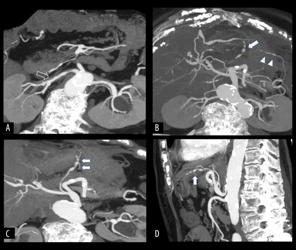 Case 1. (A–D) Multiplanar-CT reconstructions (MPR) show multiple alterations of splanchnic vessels, such as a right renal artery mimic a fibromuscular dysplasia aspect (open arrow in A), a ‘string of beads’ appearance of the left gastric artery (white arrow in B–D), right gastroepiploic artery, and anastomotic arcades of the middle colic artery and left colic artery and ileal and jejunal branches from the superior mesenteric artery (white arrowheads).