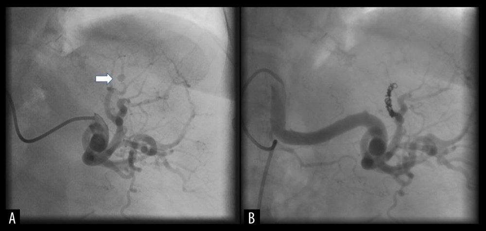 Case 1. Catheter angiogram of the splenic artery via the coeliac axis shows a distal pseudo-aneurysm marked in (A) by white arrow. (B) Catheter angiogram post-coil embolization: the pseudo-aneurysm was successfully occluded.