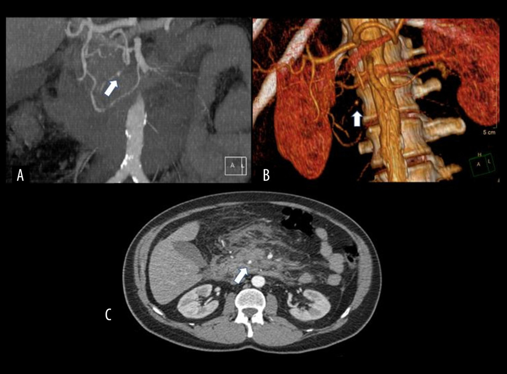 Case 2. (A–C) Coronal-CT, three-dimensional reconstruction and axial-CT images show an inferior pancreaticoduodenal artery pseudo-aneurysm formation (white arrow) and fat stranding in the peripancreatic space, with an anatomical variant subtype consisting of an inferior pancreaticoduodenal artery (IPA) originating from an accessory right hepatic artery from the superior mesenteric artery (SMA).