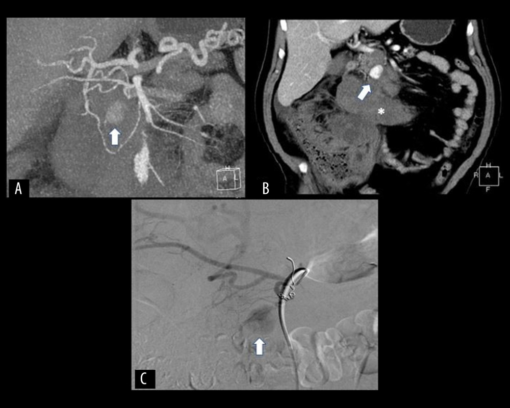 Case 2. (A, B) Two days later, the first embolization multiplanar-CT reconstructions (MPR) demonstrating the presence of a direct sign of bleeding (blush) from a branch of the inferior pancreaticoduodenal artery, distally to the embolized region (white arrow) with surrounding hematoma (asterisk). (C) Super-selective arteriography confirmed the pathological vessel, which was treated using another detachable micro-coil (white arrow).