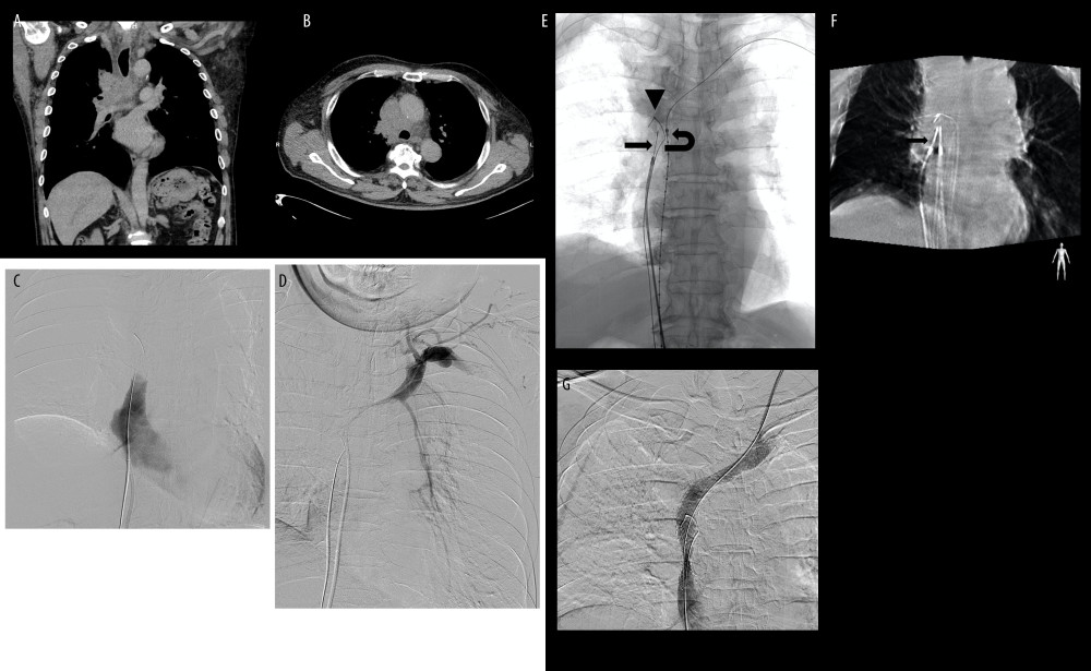 A–G were obtained from a 68-year-old man with superior vena cava syndrome. (A, B) Computed tomography demonstrates large soft tissue mass causing superior vena cava obstruction. (C, D) Intra-operative venogram demonstrates superior vena cava obstruction with a filling defect corresponding to the mass seen in the prior computed tomography study. (E, F) Live fluoroscopy with cone beam computed tomography confirms optimal positioning of the argon trans-jugular liver biopsy instrument (horizontal arrows) before biopsy samples were obtained. Note the presence of a retained guidewire from a prior vascular intervention (triangle arrow). Intravenous ultrasound is seen within the brachiocephalic vein (curved arrow). (G) Intra-operative venogram demonstrates relief of the superior vena cava obstruction after stenting.