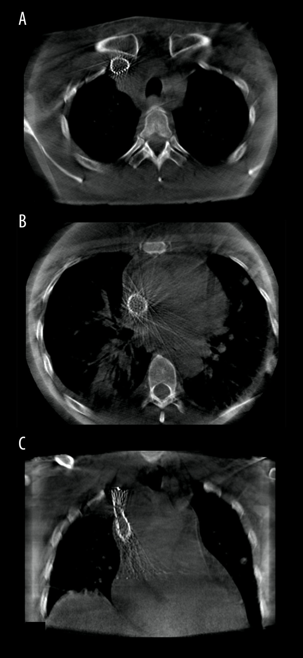 A–C were obtained from a 43-year-old woman with superior vena cava syndrome. Cone beam computed tomography images demonstrating the position of the superior vena cava stent deployed, with no immediate complications.