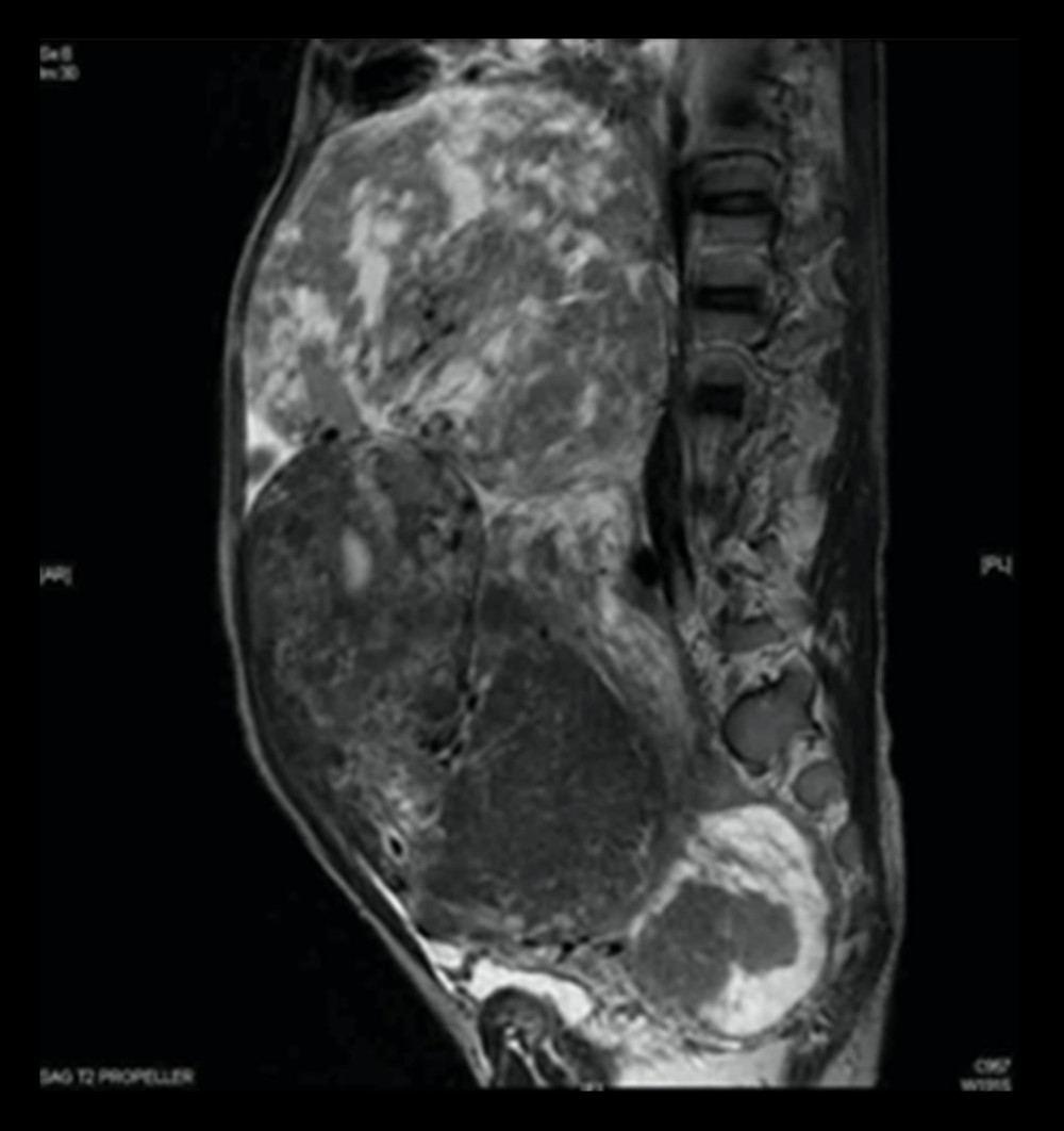 A sagittal T2 magnetic resonance image showing the same mass extending from the pelvis up to the subdiaphragmatic area displacing the uterus anteriorly.
