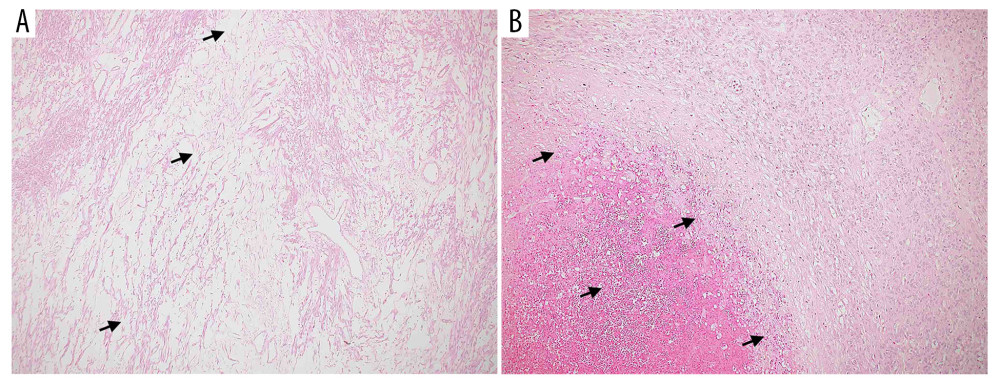 (A) A section from the largest fibroid showing areas of cystic hydropic degeneration (arrows) (H&E stain, ×40). (B) Foci of infarct-type necrosis with a rim of hyalinization (arrows). Note the absence of nuclear atypia (H&E stain, ×100).