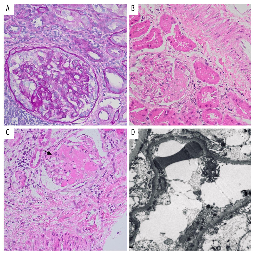 (A) In August 2016, an image representative of a glomerulus involvement by segmental sclerosis: segmental obliteration of a capillary loop segment with associated expansion of mesangial matrix by hyaline matrix, in a non-characteristic localization appearing red, PAS stain, ×400. A capsular adhesion of the corresponding segment is present. (B) In May 2019, the image demonstrates glomeruli involvement, in a non-characteristic localization, by segmental sclerosis and capsular adhesion, H&E stain, ×400. (C) In May 2019, the image demonstrates a corticomedullary glomerulus involvement by segmental sclerosis and capsular adhesion, H&E stain, ×400. (D) An electron microscopic image demonstrates effacement and fusion of podocyte foot processes over long segments (>90%) of the glomerular basement membranes, EM, ×2000.