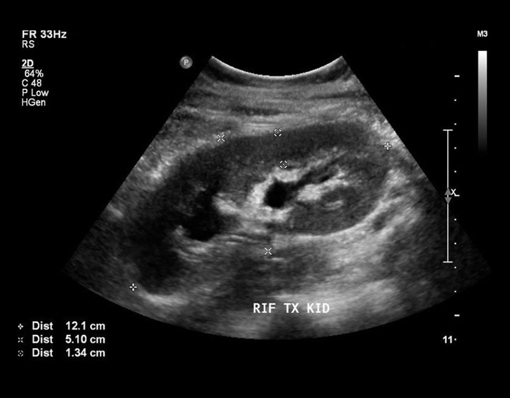 Renal ultrasound the transplanted kidney with a size of 12×5.1 cm and cortical thickness of 1.3 cm.