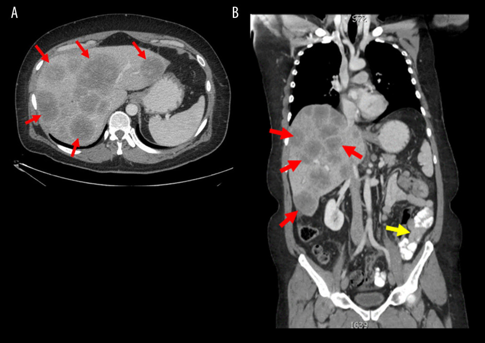 CT of chest, abdomen, and pelvis in (A) an axial cut and (B) in a coronal cut showing circumferential descending colon wall thickening (yellow arrow) and innumerable hypovascular ring-enhancing hepatic masses scattered in both lobes involving all liver segments (red arrows).
