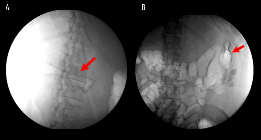 (A, B) X-ray post-endoscopic stenting of the site of colonic wall thickening (red arrows).