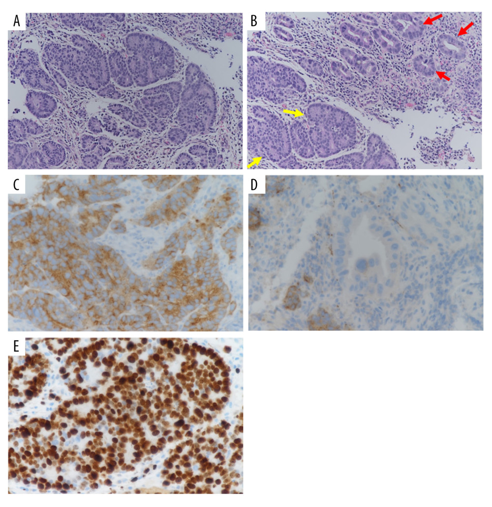 Microscopic examination of the colonoscopic biopsy showing: (A) Section shows a large cell neuroendocrine carcinoma with organoid and rosette-like growth pattern (200× magnification; H&E). (B) Adenocarcinoma component as demonstrated by highly atypical structures (Red arrows) intermingled with neuroendocrine carcinoma (yellow arrows) (200×, H&E). (C) Synaptophysin immunohistochemical stain is diffusely positive in the neuroendocrine carcinoma component. (D) Synaptophysin immunohistochemical stained negative in adenocarcinoma component (400×). (E) Ki-67 proliferative index in neuroendocrine carcinoma is estimated at >90% (400×).
