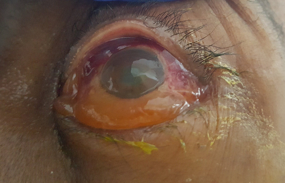 Left eye on presentation. There was 2+ conjunctival injection and extensive chemosis.