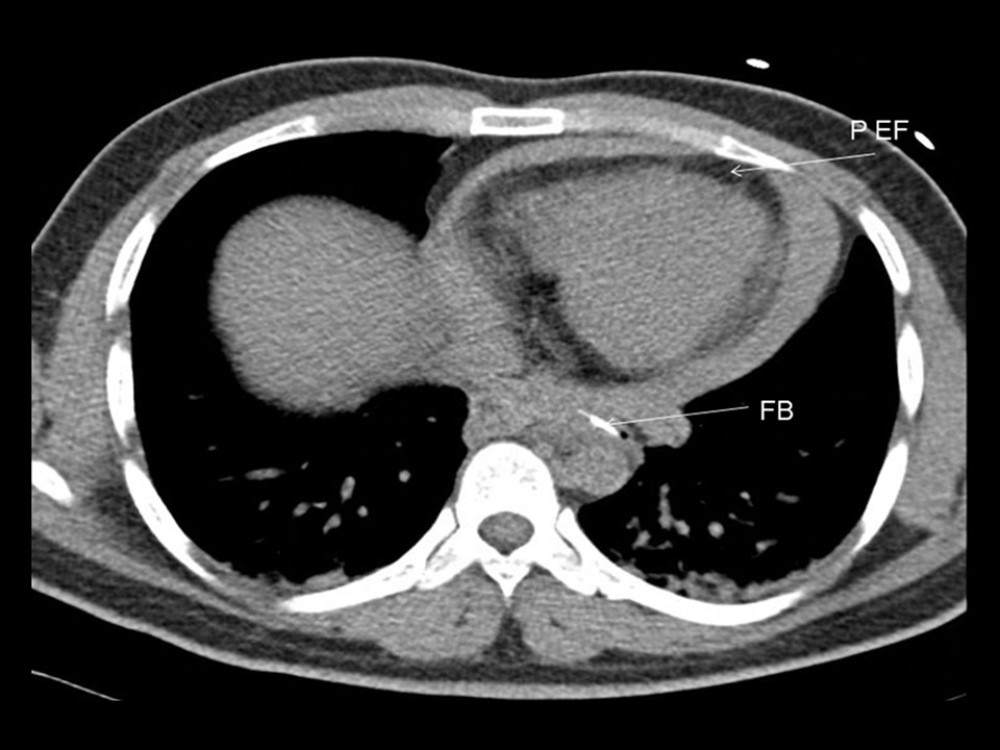 Computed tomography scan with arrows pointing to the foreign body (FB) and pericardial effusion (PEF).