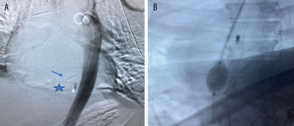 (A) The aortogram showing the intact aorta, foreign body (arrow), and clip (asterisk) placed by esophago-gastroduodenoscopy. (B) Inflated balloon of resuscitative endovascular balloon occlusion of the aorta (REBOA).