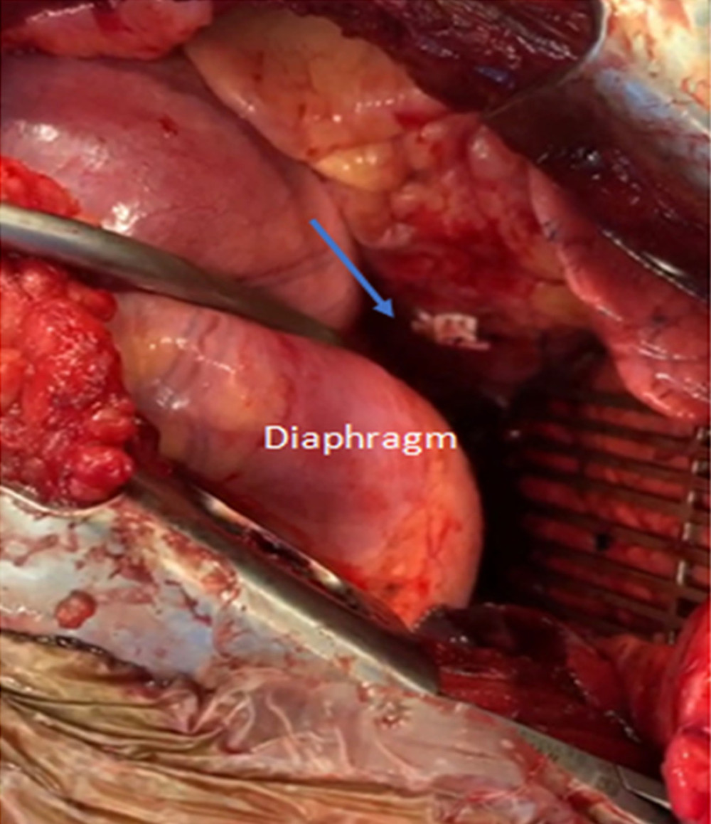 The left thoracotomy. Pledgeted sutures with arrow indicate area of repair with pledgeted sutures over the left atrium.