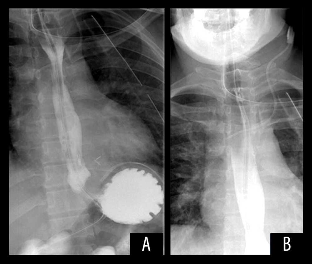 (A, B) The patient’s barium swallow showing no contrast leak.