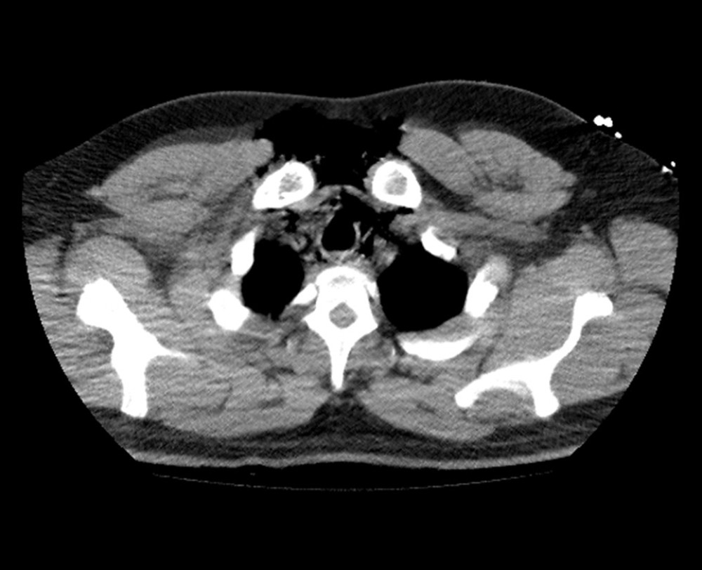 Thoracic CT at day 1: Pneumomediastinum and soft-tissue emphysema.