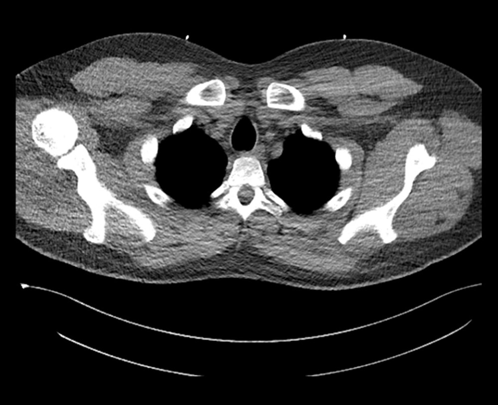 Thoracic CT at day 6: Pneumomediastinum and soft-tissue emphysema completely regressed.