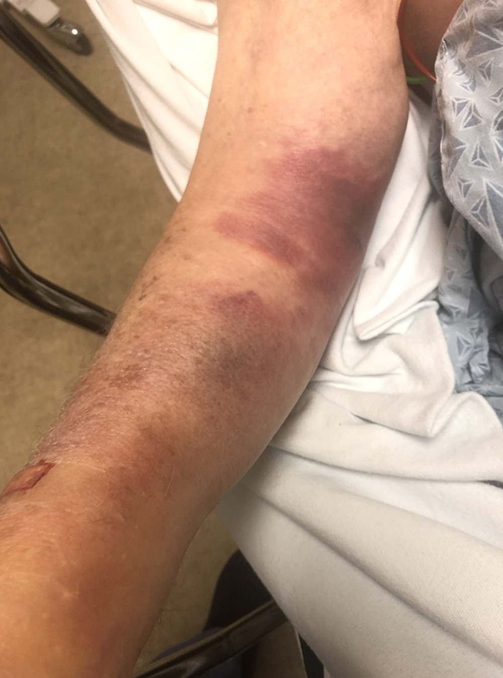 Bedside image of the patient’s right forearm taken in the Emergency Department revealing severe swelling and ecchymosis.