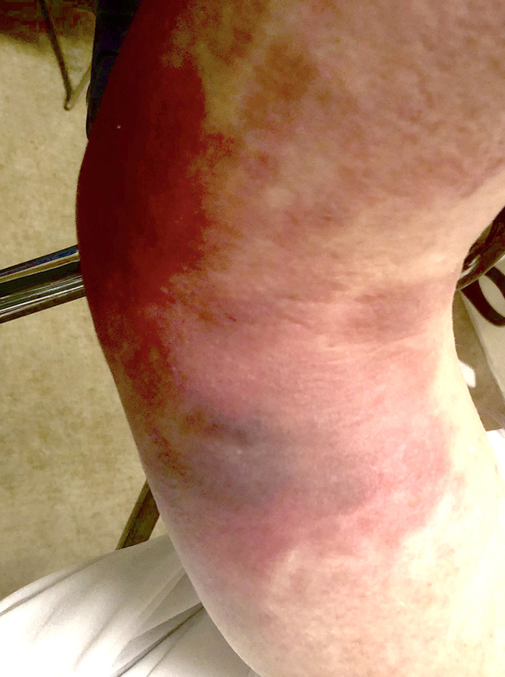 Bedside image of the patient’s right elbow taken in the Emergency Department revealing severe swelling and ecchymosis.