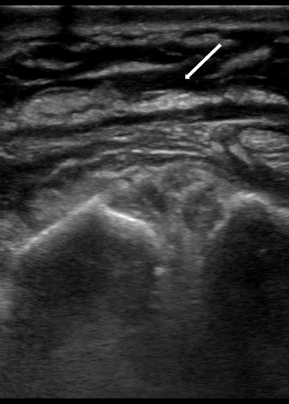 Diffuse interstitial edema of the right arm soft tissue shown on bedside ultrasound in the Emergency Department (arrow).