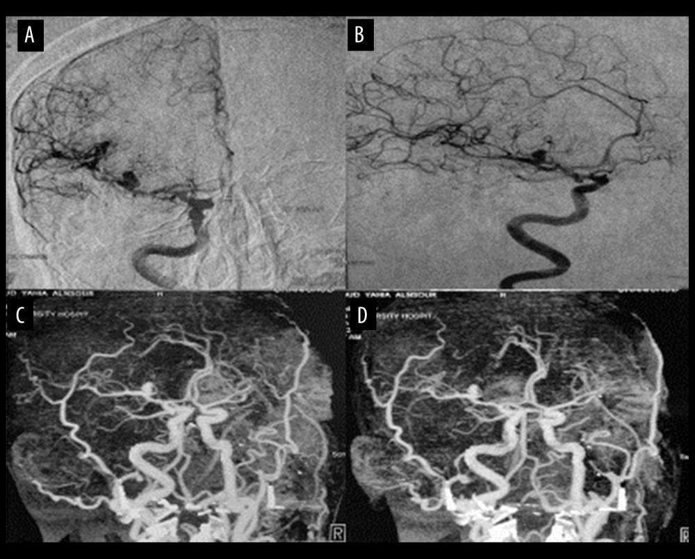 (A, B) Preoperative angiogram after contrast injection of the right carotid artery, confirming the presence of a sacular aneurysm of the middle cerebral artery in segment M1. (C, D) Preoperative computed tomography angiogram confirming the presence of a right sacular aneurysm of the middle cerebral artery segment M1.