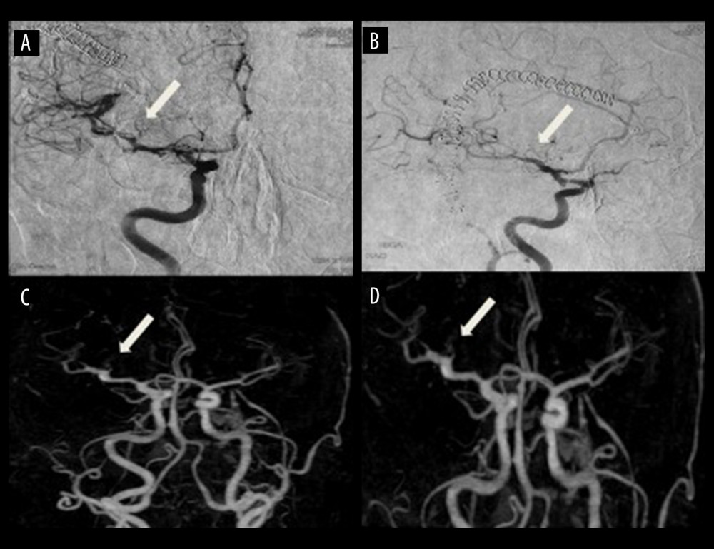 (A–D) Postoperative angiogram of the right internal carotid artery 1 week after surgical clipping. A clip was placed on the previous M1 right middle cerebral artery aneurysm (white arrows).