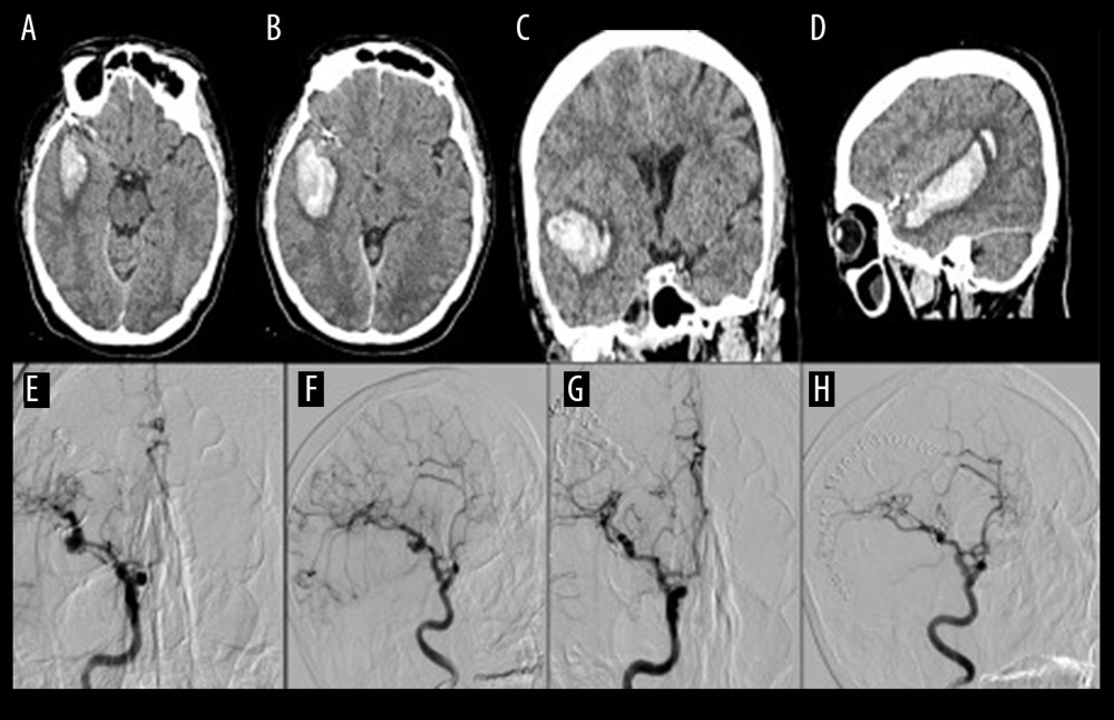 (A–D) Brain computed tomography with contrast 8 years after surgery showing a right temporal lobe hematoma, extending from the Sylvian fissure medially, posteriorly, and superiorly with a mild mass effect. (E, F) Selected angio-gram of the right internal carotid artery showing a multilobulated brain aneurysm in the M1 segment at the side opposite the previous clip. (G, H) Follow-up angiogram 1 week after microsurgical clipping; no residual brain aneurysms were observed.