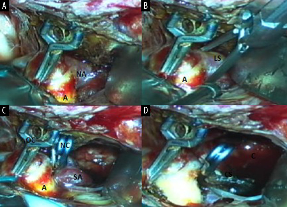 Intraoperative microsurgical view of the second surgery (A) showing an atheroma in middle cerebral artery close to the neck of the aneurysm, neck of the de novo aneurysm (NA); (B) showing the atheroma and lobulated sac of the aneurysm. (C) Old aneurismal clip (OC), new aneurismal clip (NC), atheroma (A), sacular aneurysm after clipping (SA). (D) Aneurysm sac (CS) cauterized after clipping and the cavity (C) of the temporal lobe hematoma after evacuation.