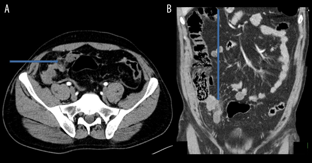 (A, B) Selected images of the abdomen in axial and coronal planes show focal mesenteric fat stranding in the right iliac fossa with no evidence of contrast blush or pseudo-aneurysm in the arterial or portal venous phases (arrows).