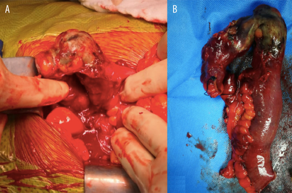 (A) Intraoperative finding of large amount of blood and ischemic terminal ileum about 5 centimeters from the ileocecal valve. (B) Limited right hemi-colectomy with primary anastomosis.