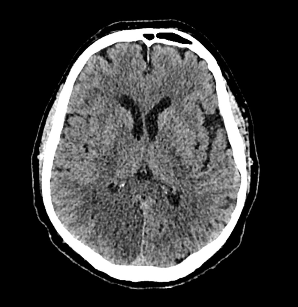 Brain multi-spiral computed tomography performed in 2016 showing ischemic brain damage in the right occipital lobe.