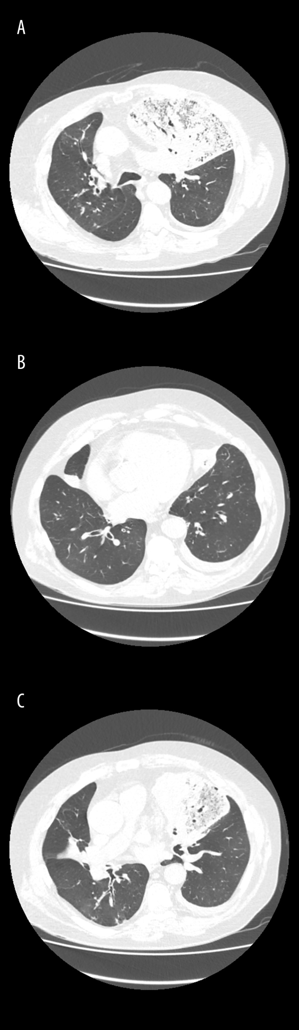 (A–C) Chest computed tomography of patient showing large left upper lobe pneumonia and bronchiectasis in lover lobes.